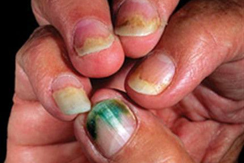 Pseudomonas - Green Nails and Mold